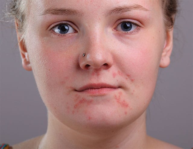 Imagen de acné en la cara.  Imagen 82534531 con licencia de Shutterstock por Photoshop Essentials.com