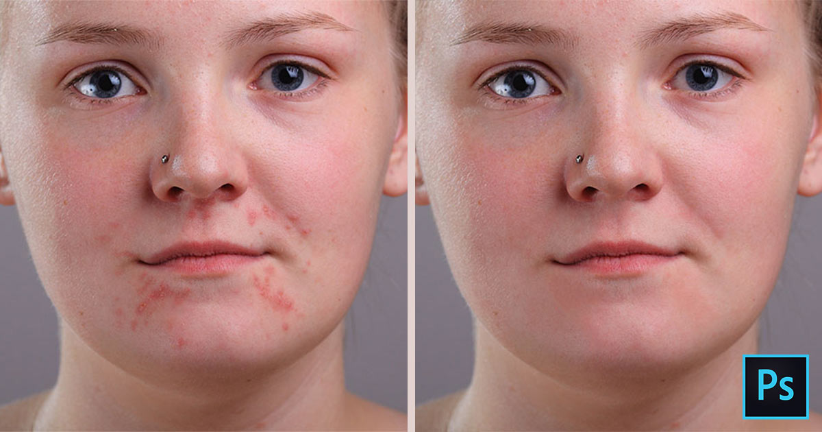 Cómo eliminar el acné y las imperfecciones de la piel en el tutorial de Photoshop