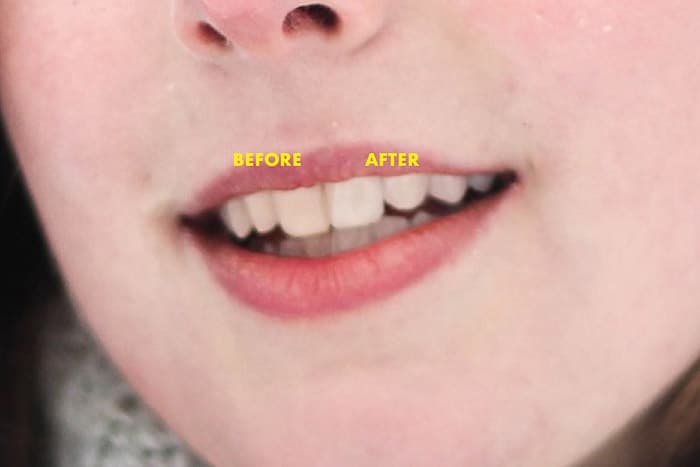 Un retrato de cerca de una boca de modelos femeninos antes y después del blanqueamiento dental con Photoshop