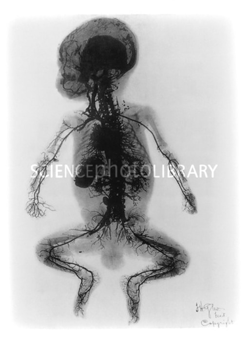 ^Arteriograma de rayos BX de un niño (1899).^b Radiografía temprana que muestra con gran detalle las arterias del cuerpo de un niño.  La radiografía se realizó en 1899 en el St. Thomas' Hospital de Londres y se publicó en los ^IArchives^i ^Iof the Roentgen Ray.^i Se tituló: "Un bebé inyectado".  El cadáver de un niño fue inyectado, en la arteria femoral de la pierna, con cuatro libras de mercurio.